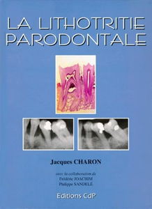La Lithotritie parodontale